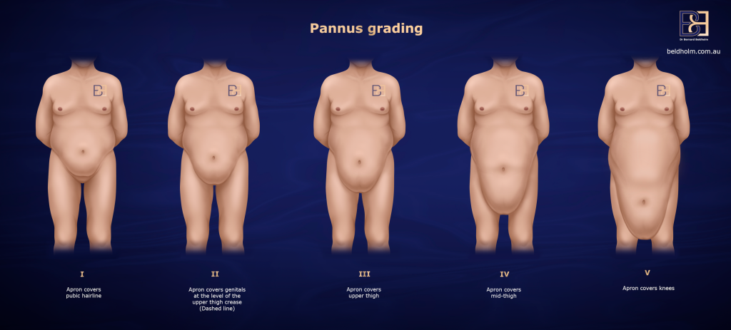 Understanding Abdominoplasty Post Weight Loss and Bariatric Surgery 16 Apron grading scale for Apronectomy surgery