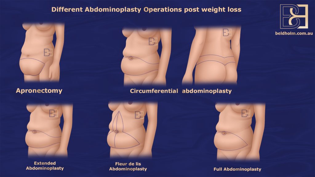 Understanding Abdominoplasty Post Weight Loss and Bariatric Surgery 2 Different types of abdominoplasty procedures