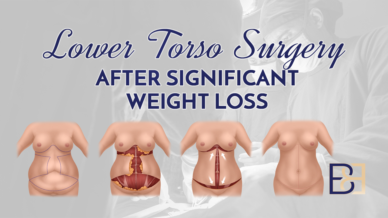 Lower Torso Surgery After Significant Weight Loss