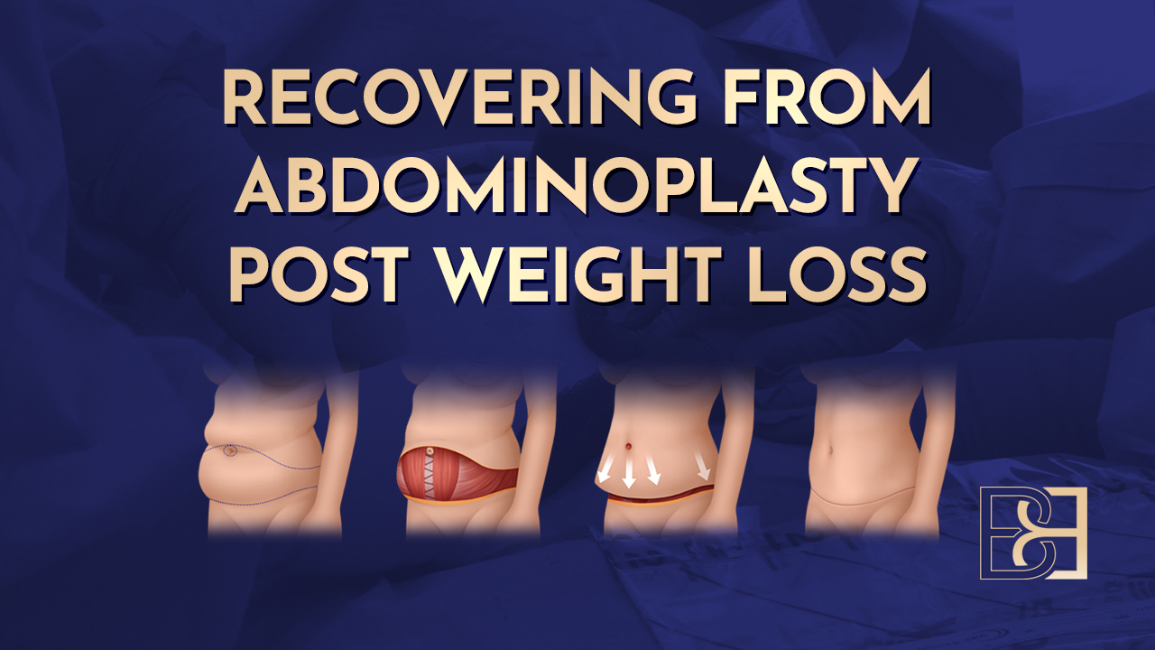Recovering from Abdominoplasty Post Weight Loss (Standard & Extended Abdominoplasty)