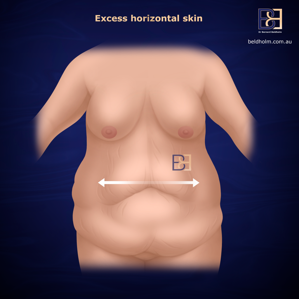 Understanding Abdominoplasty Post Weight Loss and Bariatric Surgery 9 Excess horizontal skin