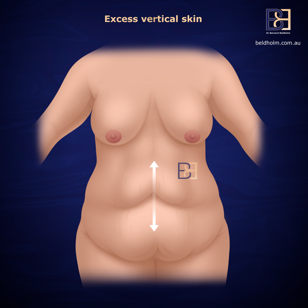 Understanding Abdominoplasty Post Weight Loss and Bariatric Surgery 8 Excess vertical loose skin