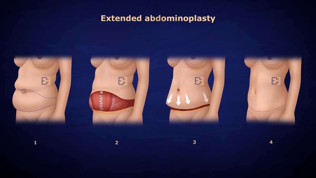 Understanding Abdominoplasty Post Weight Loss and Bariatric Surgery 11 Extended Abdominoplasty