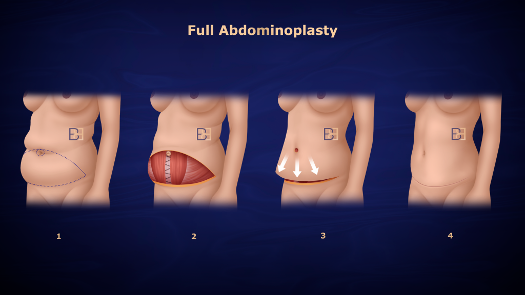 Understanding Abdominoplasty Post Weight Loss and Bariatric Surgery 10 Full (Standard) Abdominoplasty
