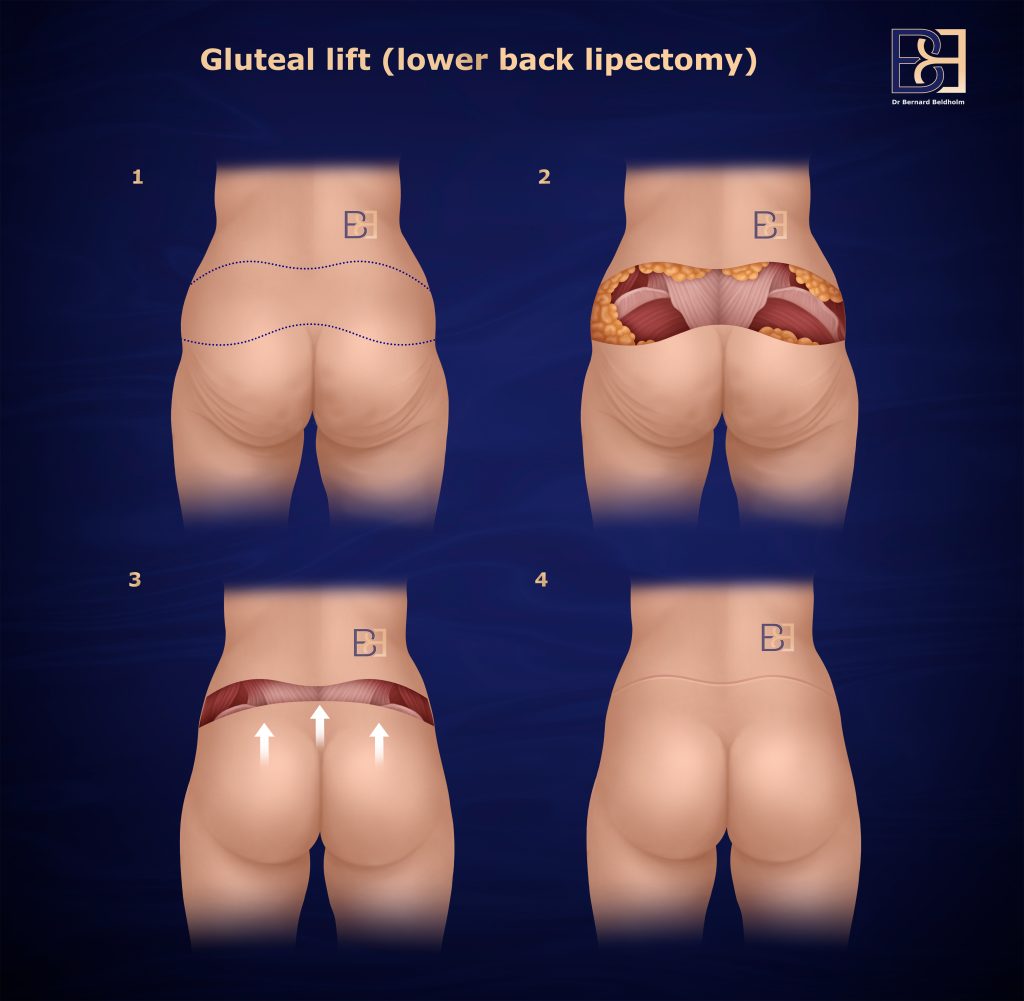 Gluteal Lift - Lower Back Lipectomy