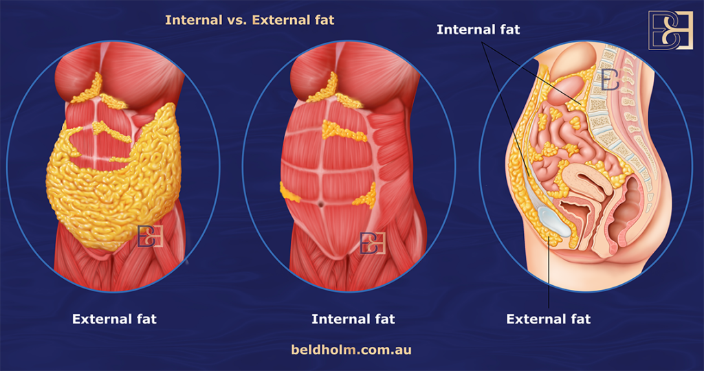 Understanding Abdominoplasty Post Weight Loss and Bariatric Surgery 13 Internal vs external fat (adipose tissue)