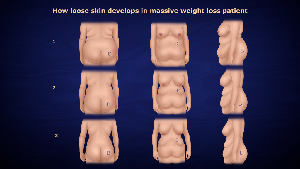 Understanding Abdominoplasty Post Weight Loss and Bariatric Surgery 4 Loose skin developing after weight loss Dr Beldholm