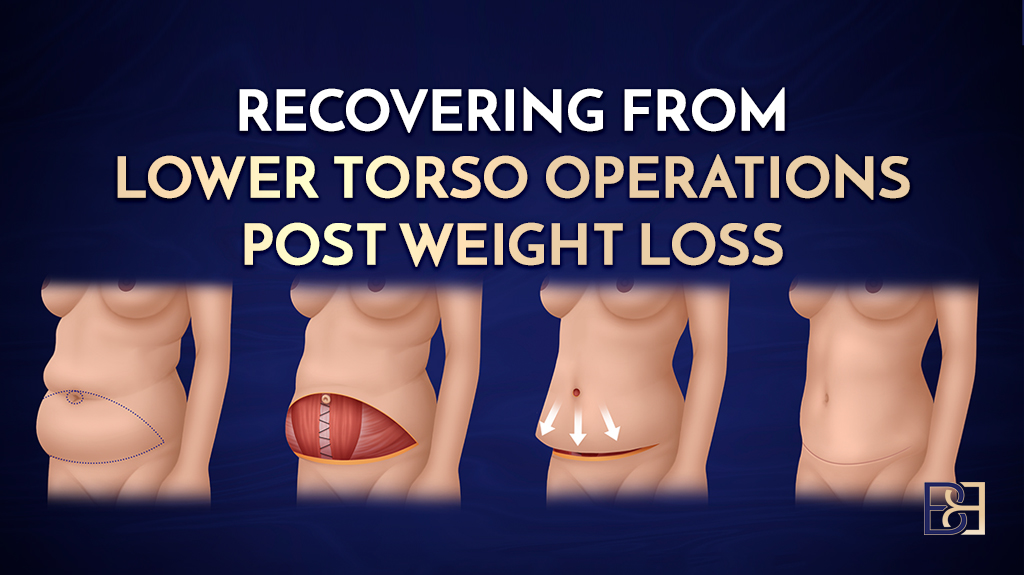 Recovering from Lower Torso Surgery After Significant Weight Loss