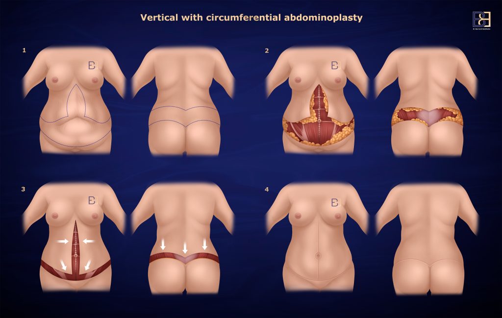 Vertical with Circumferential Abdominoplasty