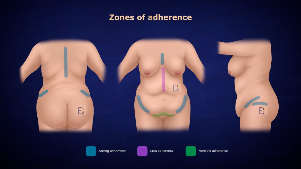 Understanding Abdominoplasty Post Weight Loss and Bariatric Surgery 1 Zones of adherence causing patterns of loose skin on the abdomen