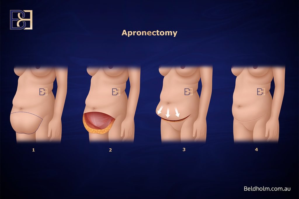 Apronectomy