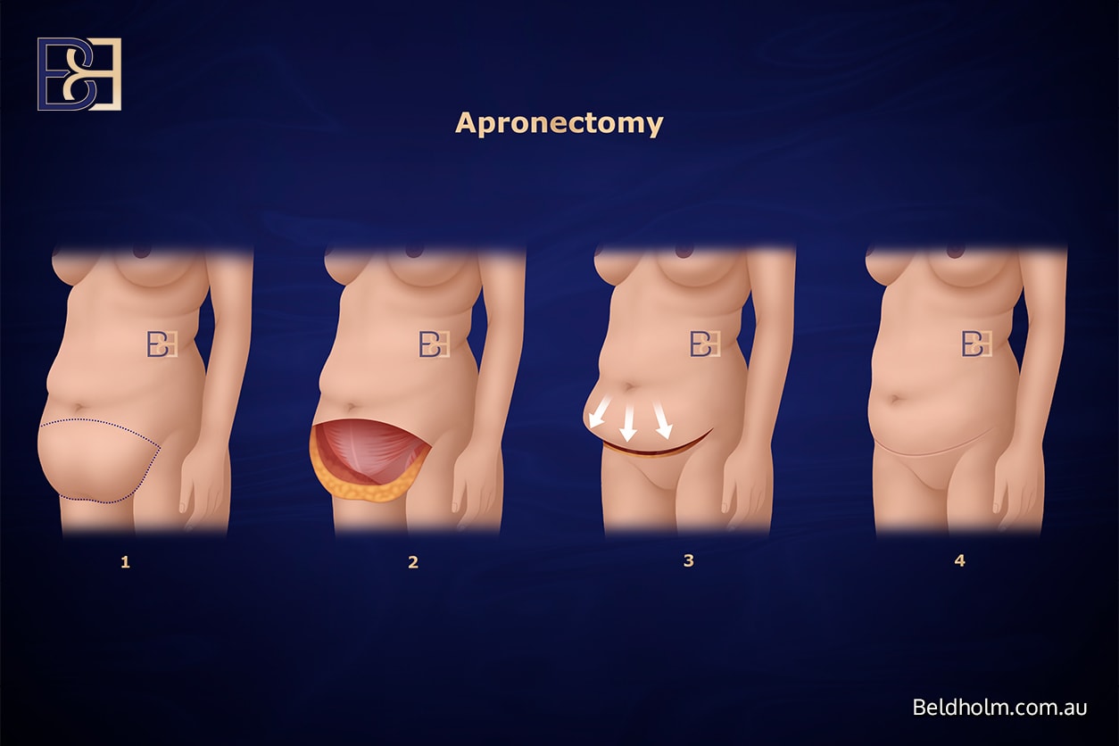 Apronectomy
