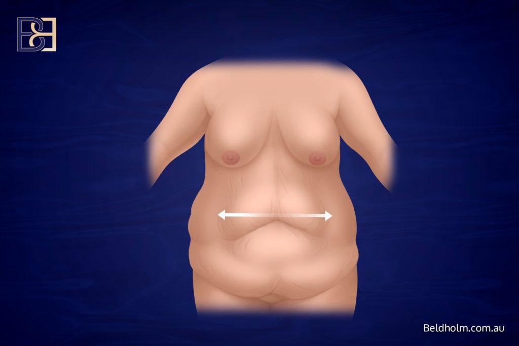 Complications from Lower Torso Operations Post Weight Loss 1 horizontal excess loose skin in abdominal area