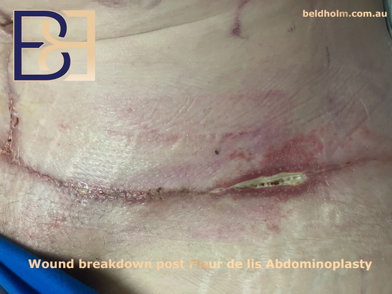 Complications from Lower Torso Operations Post Weight Loss 7 Wound breakdown after Fleur de lis abdominoplasty