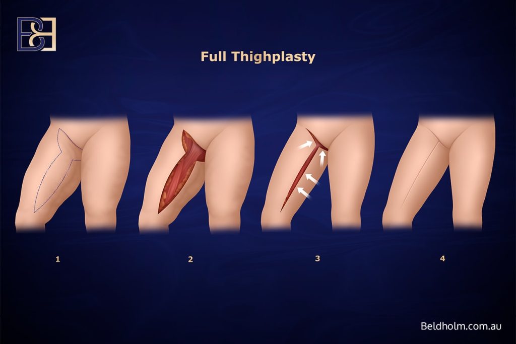 Recovering from Lower Torso Surgery After Significant Weight Loss 9 Thigh Lift (Inner Thighplasty)