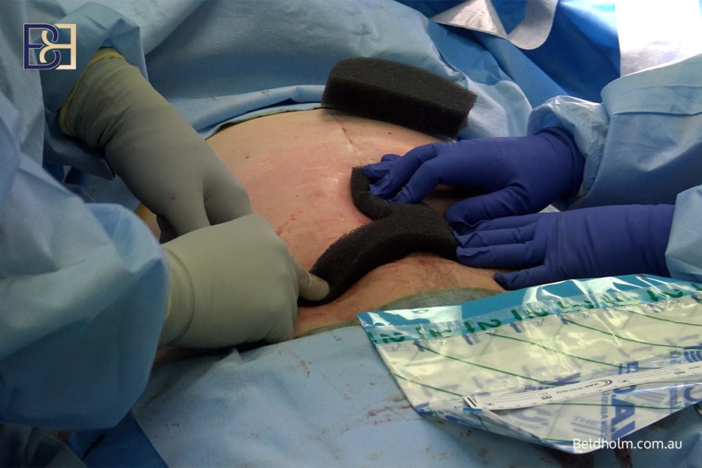 Recovering from Lower Torso Surgery After Significant Weight Loss 11 Lower Torso Surgery - Factors That Influence Recovery