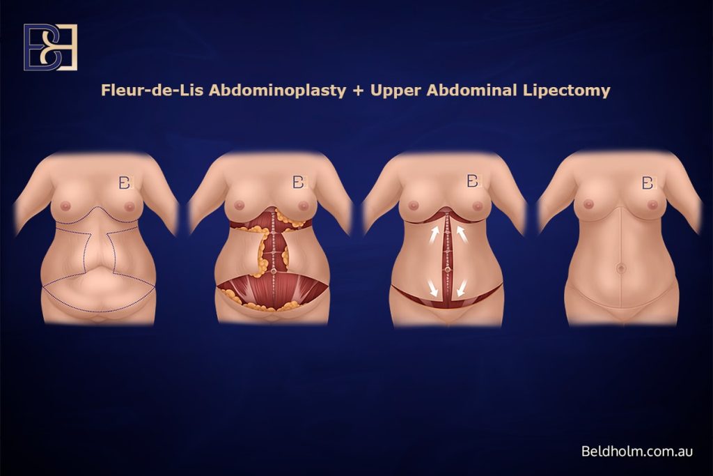 Complications from Lower Torso Operations Post Weight Loss 12 Fleur de lis abdominoplasty combined with an upper abdominal lipectomy