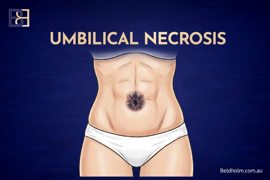 Umbilical Necrosis
