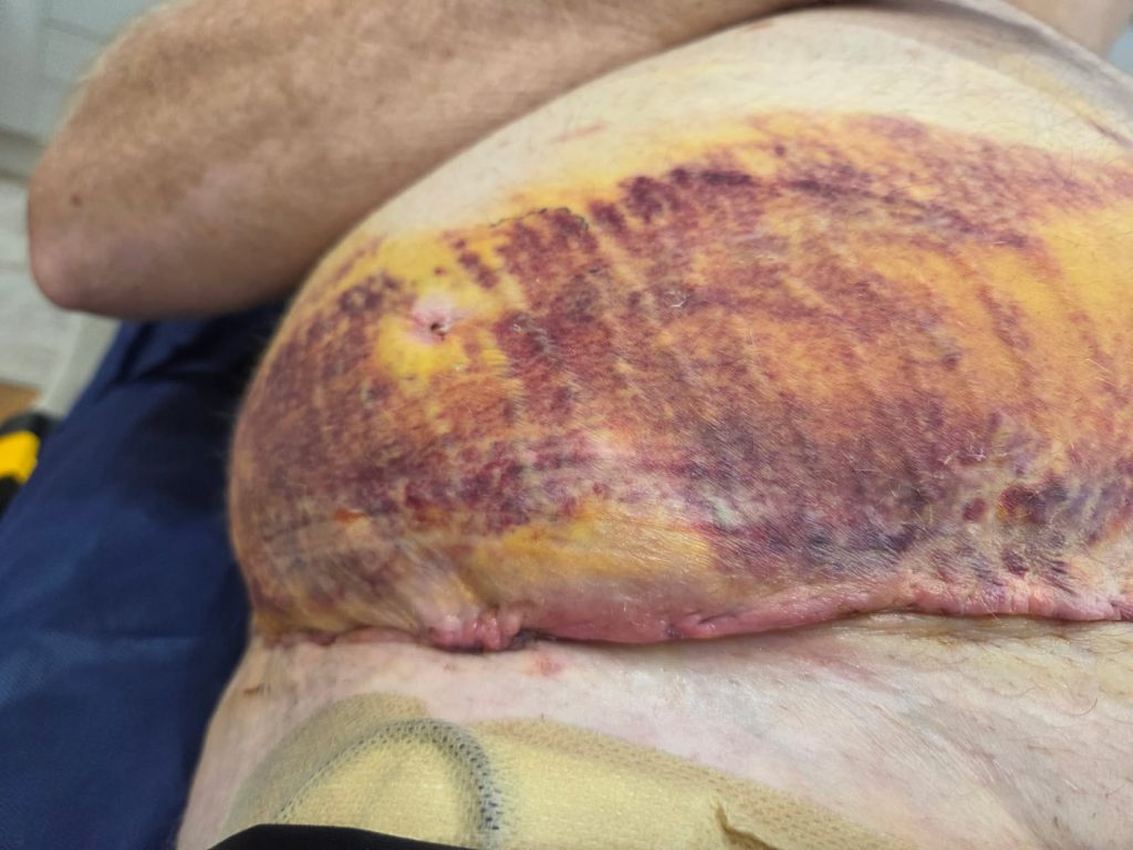 Haematoma post surgery