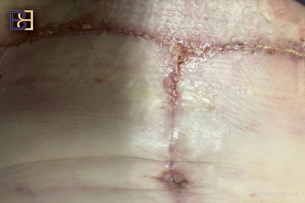 Complications from Lower Torso Operations Post Weight Loss 8 Lower Torso Surgery Complication - Raised scars
