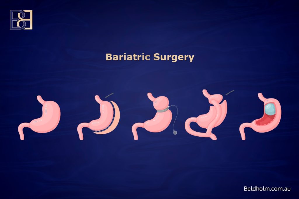 Complications from Lower Torso Operations Post Weight Loss 9 Different bariatric surgery