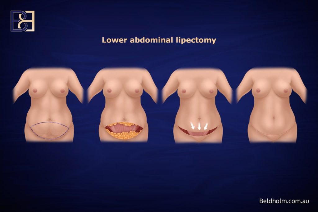 Upper + Lower Abdominal Lipectomy
