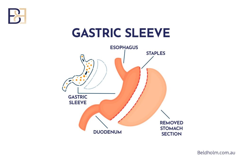 Recovering from Abdominoplasty Post Weight Loss (Standard & Extended Abdominoplasty) 1 Gastric Sleeve Surgery