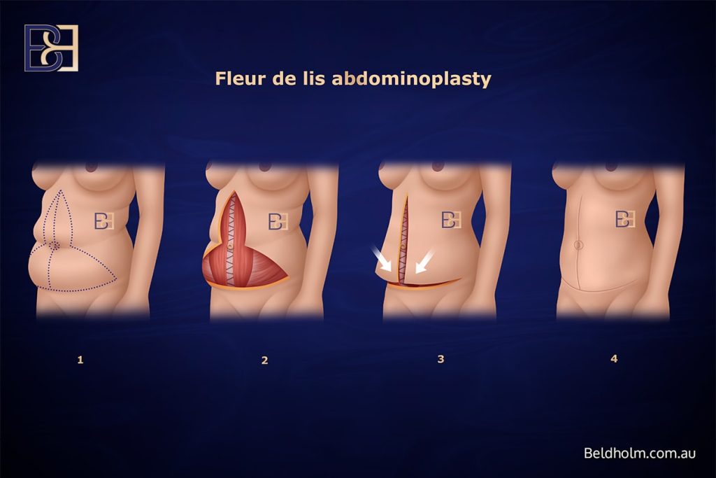 Fleur de lis abdominoplasty