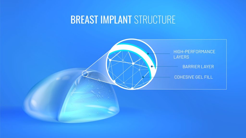 Breast Implant Structure