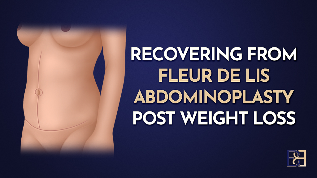 Recovering from Fleur-de-Lis Abdominoplasty Post-Weight Loss