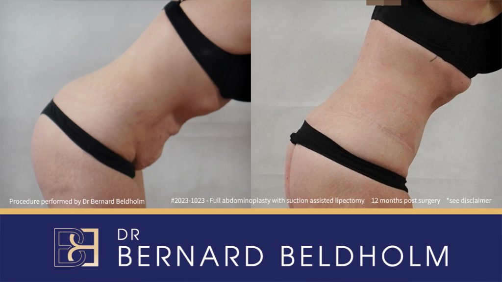 Patient 2023-1023 Full Abdominoplasty Post Pregnancy: Repair Femoral Hernia & Diastasis Recti - Left Bend