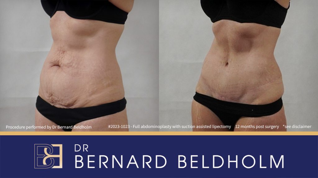 Patient 2023-1023 Full Abdominoplasty Post Pregnancy: Repair Femoral Hernia & Diastasis Recti - Right