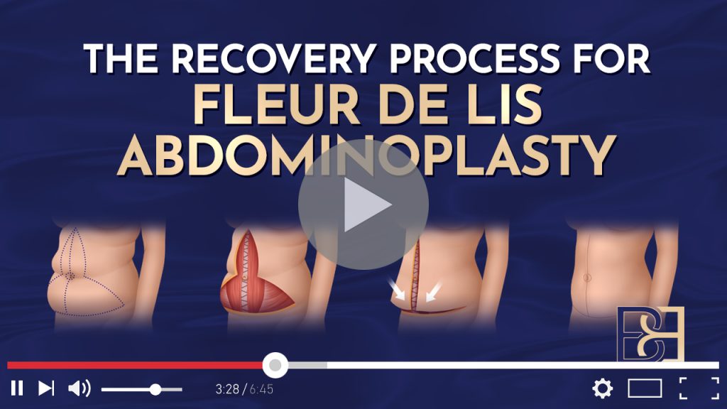 Recovering from Fleur-de-Lis Abdominoplasty Post-Weight Loss 1 Recovering from Fleur-de-Lis Abdominoplasty Post-Weight Loss