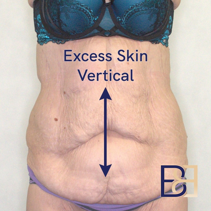 Excess Skin Vertical Ad