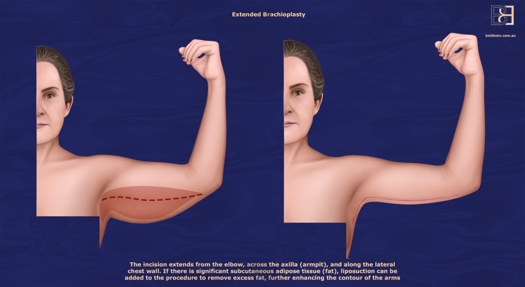 Extended Brachioplasty – Elbow to Axilla and Onto the Chest