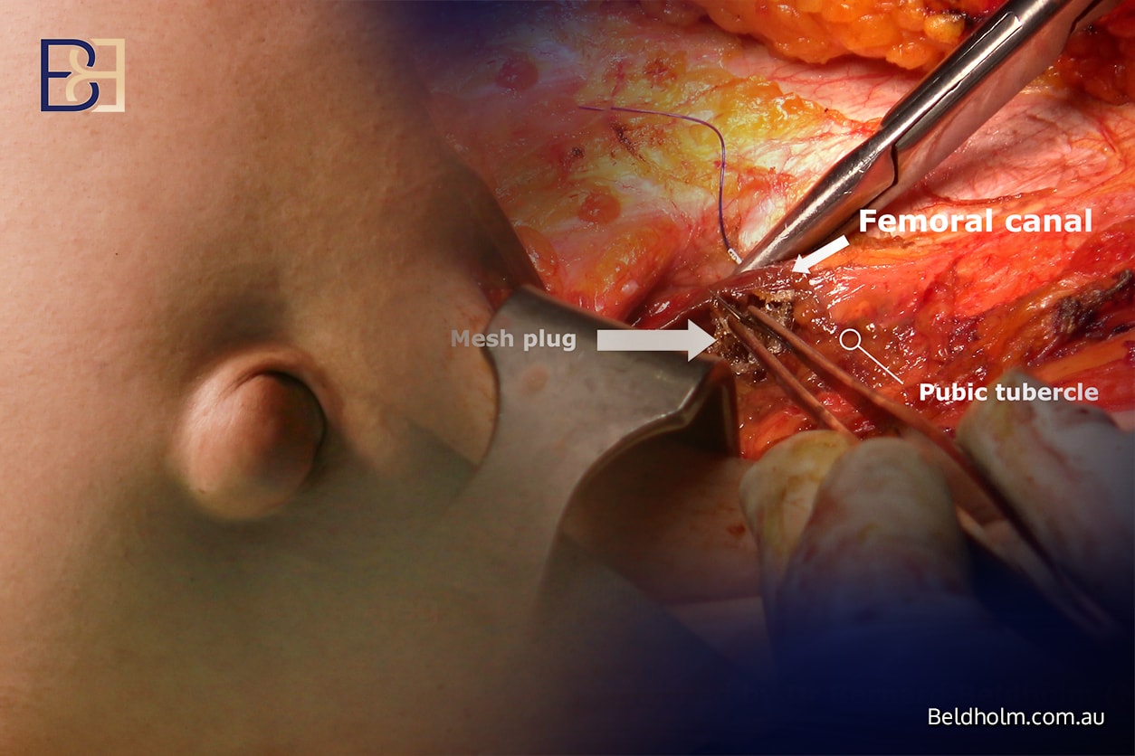 Femoral hernia repair during an abdominoplasty