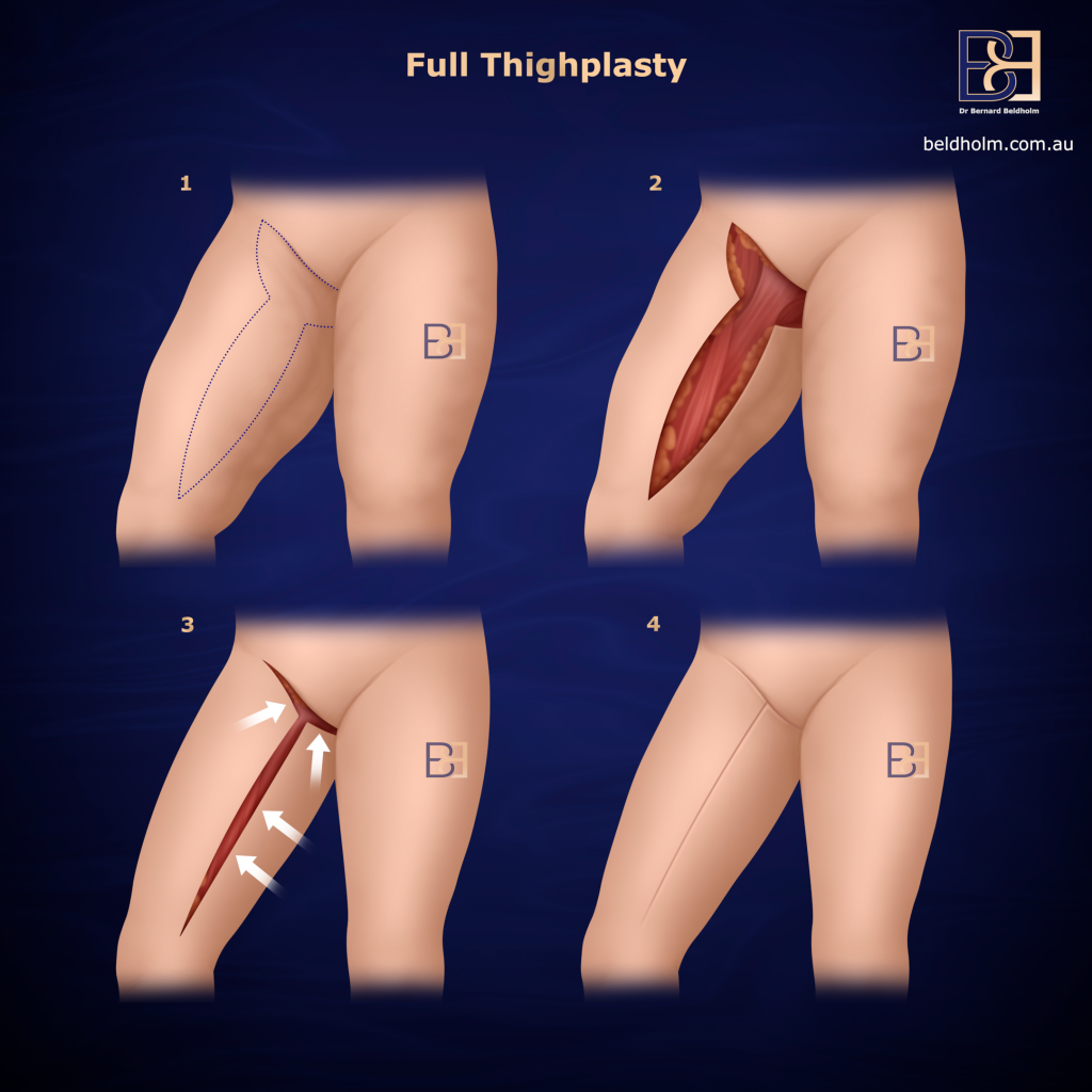 Full Medial Thighplasty
