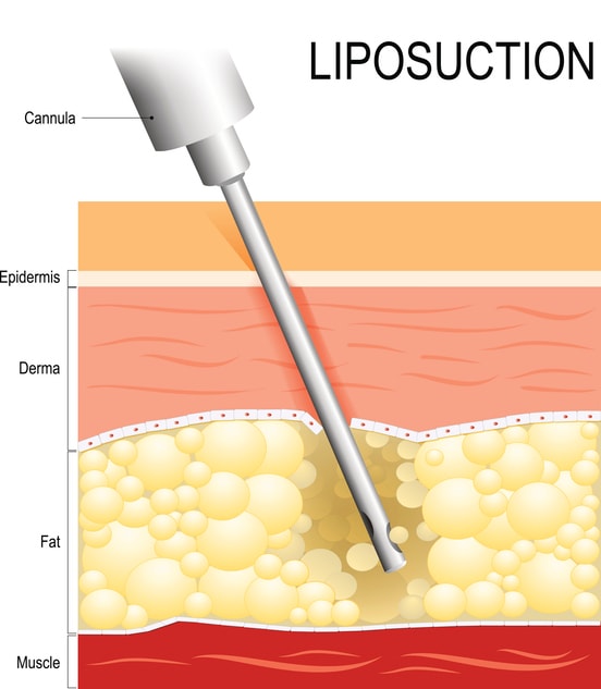 Integrated Techniques VASER Liposuction and Hernia Repair