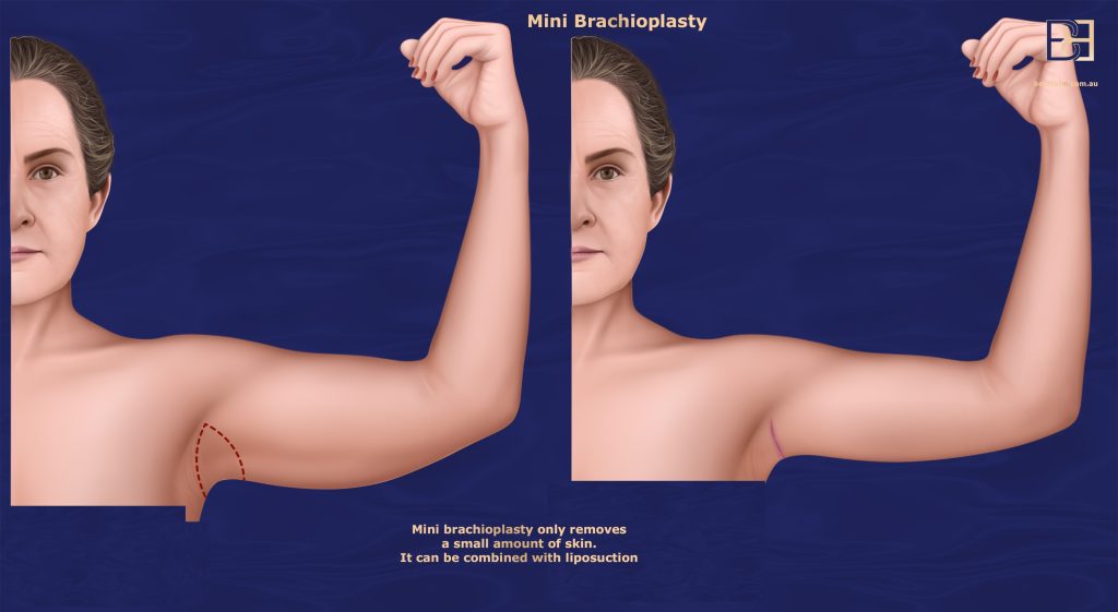 Mini brachioplasty