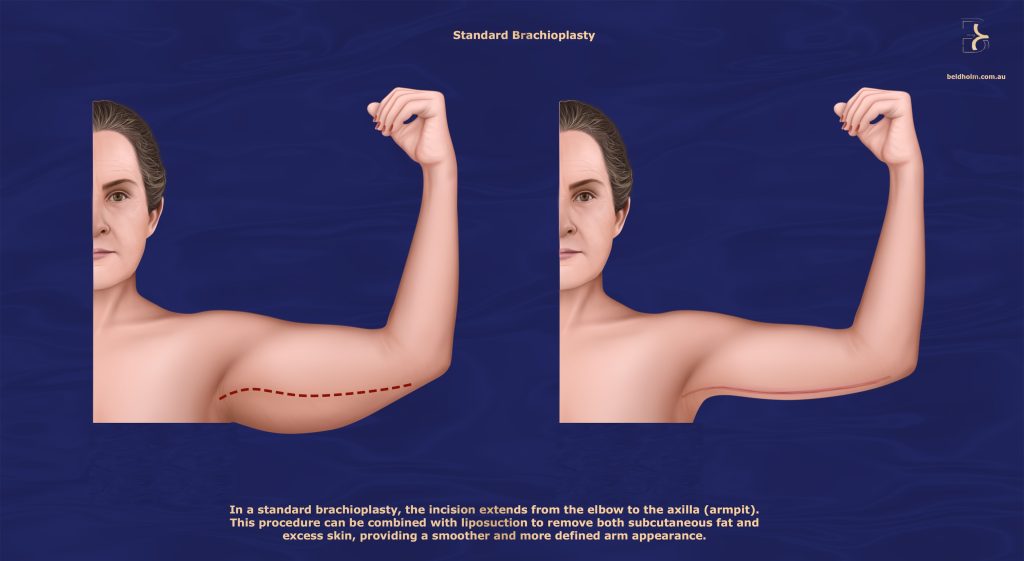 Standard (Full) Brachioplasty – Elbow to Axilla