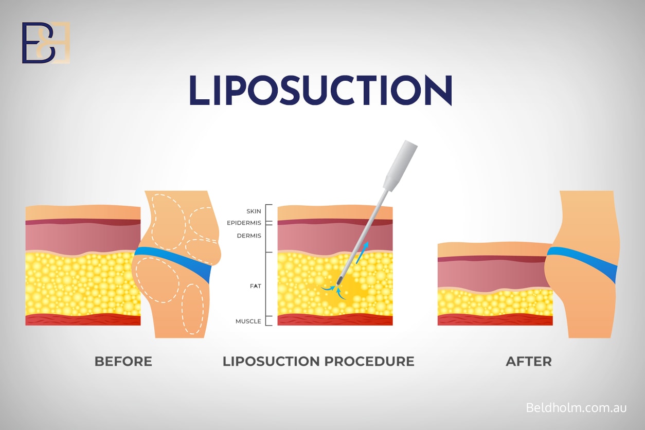 VASER Liposuction (suction-assisted lipectomy)