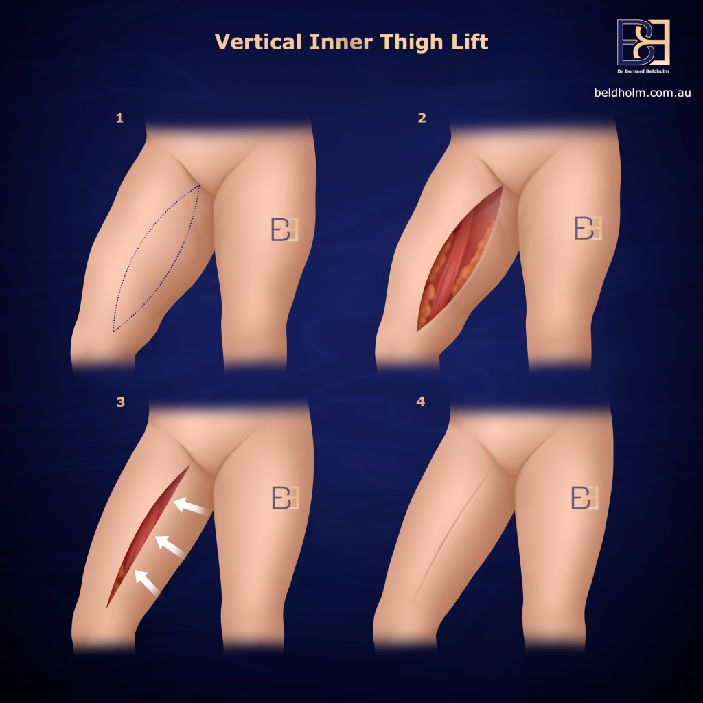 Vertical Thighplasty