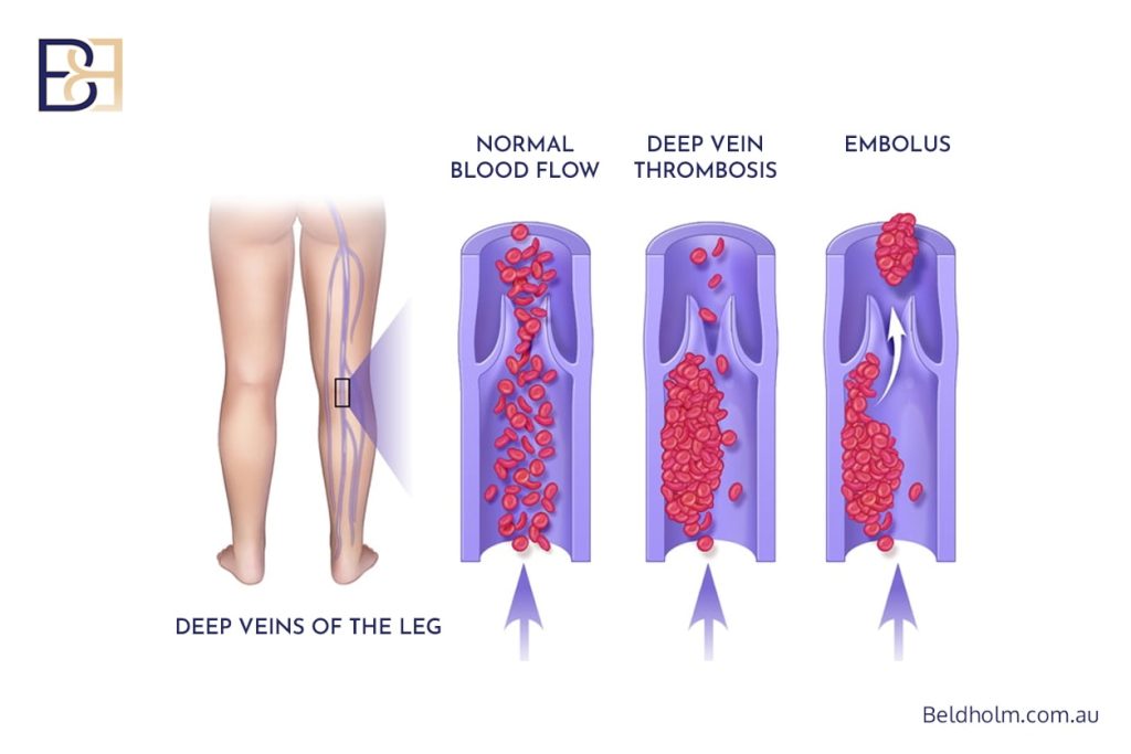 Fleur‑de‑Lis Abdominoplasty Post‑Weight Loss 19 DVT & PE