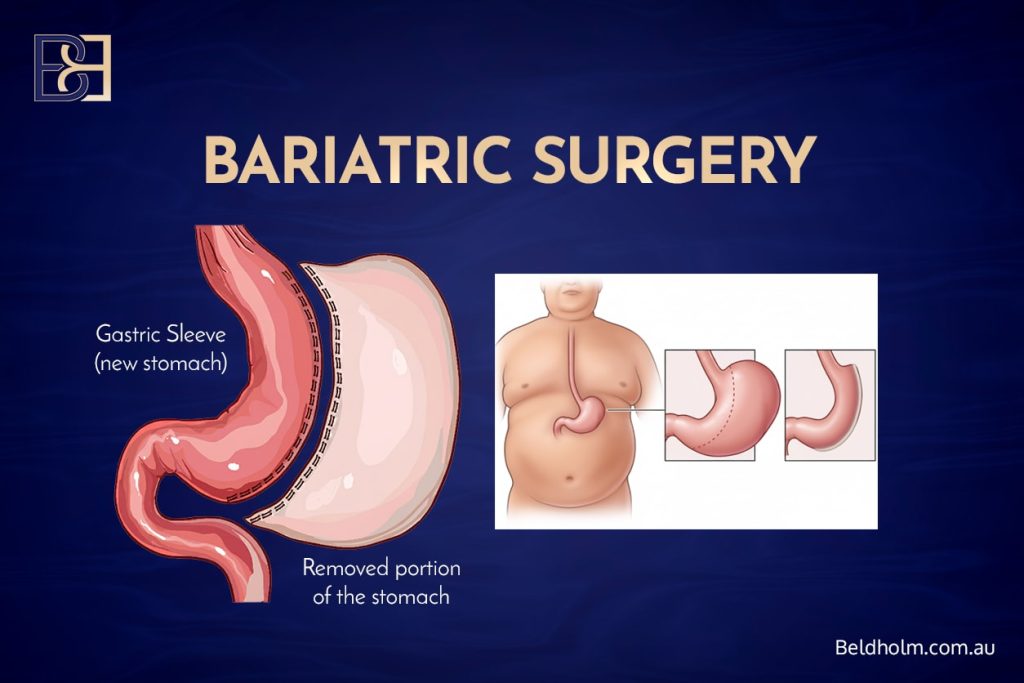 Gastric Sleeve Bariatric Surgery