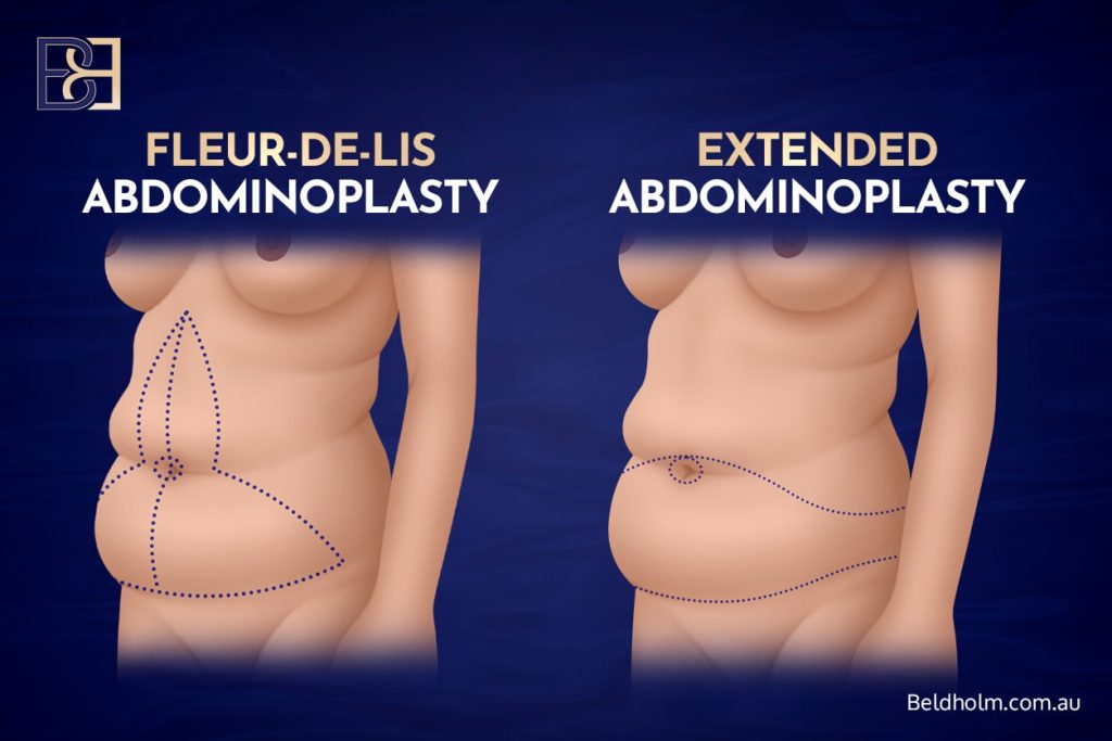 Fleur de lis abdominoplasty vs Extended Abdominoplasty