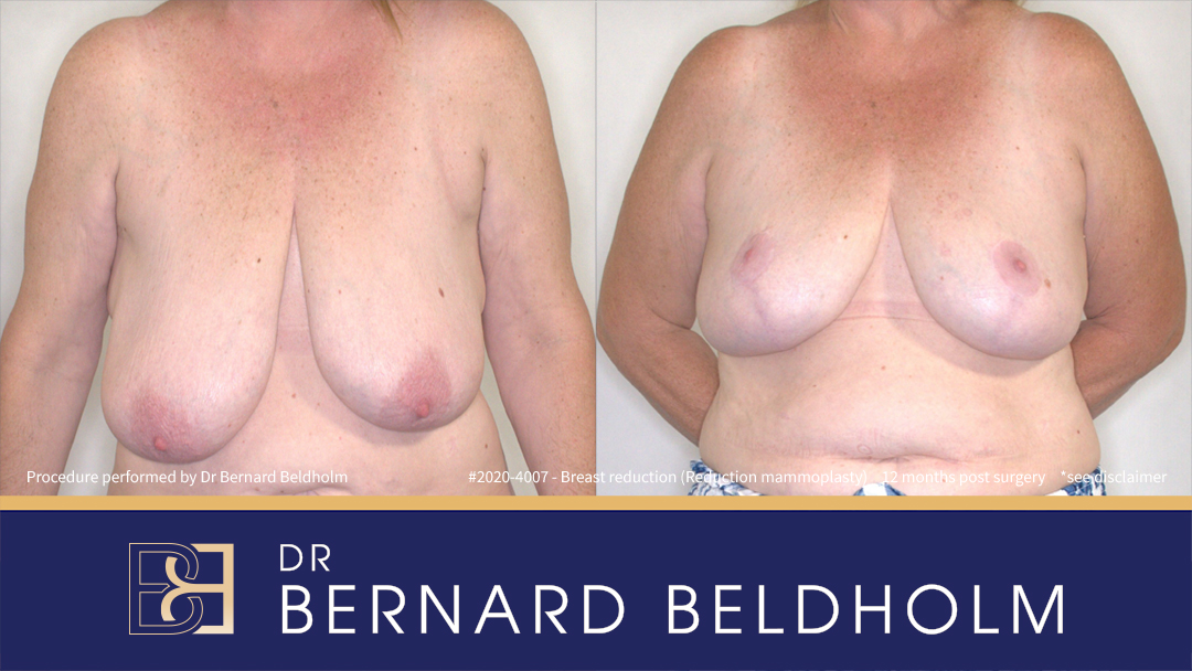Breast Reduction (Reduction Mammoplasty) for F Cup Uneven Breasts (Patient 2020-4007)