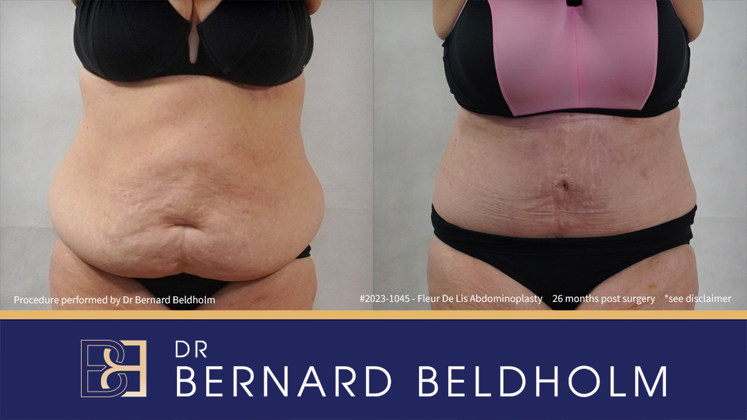 Fleur-de-Lis Abdominoplasty and Upper Abdominal Lipectomy Post Weight Loss (Patient 2023-1045)