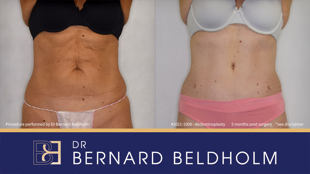 Abdominoplasty Post Weight Loss Patient 2021-1008 - Front