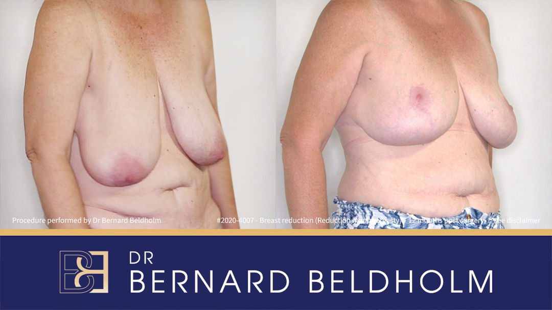 Breast Reduction (Reduction Mammoplasty) for F Cup Uneven Breasts (Patient 2020-4007) - Left