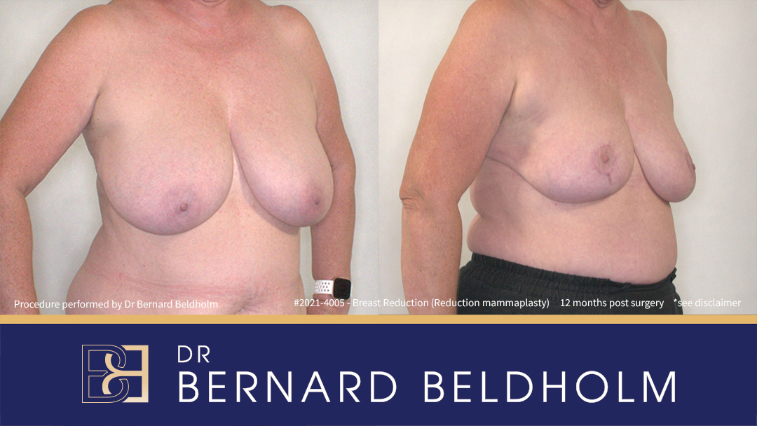 Reduction Mammoplasty (Breast Reduction) Patient 2021-4005 2 Reduction Mammoplasty (Breast Reduction) Patient 2021-4005 - Left